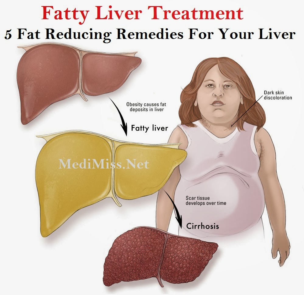 Is Orlistat Good For Fatty Liver Margaret Greene Kapsels